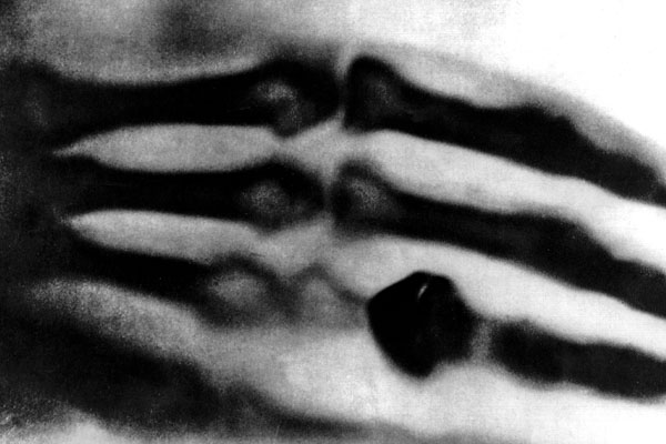 Erstes Röntgenbild mit Hand von Bertha Röntgen 1895