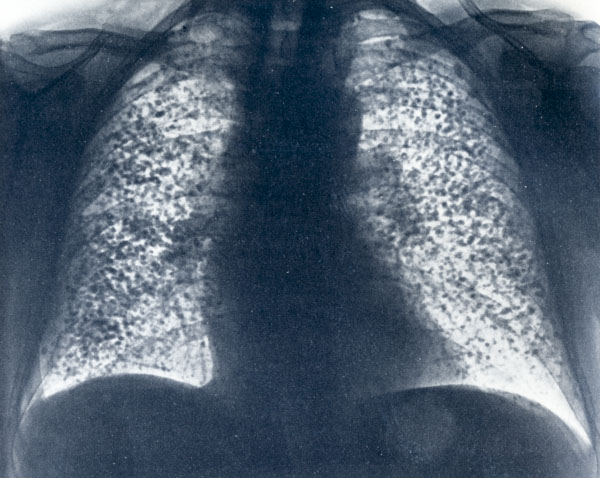 Poumons présentant des condensations, feuillet de la CNA, 1975