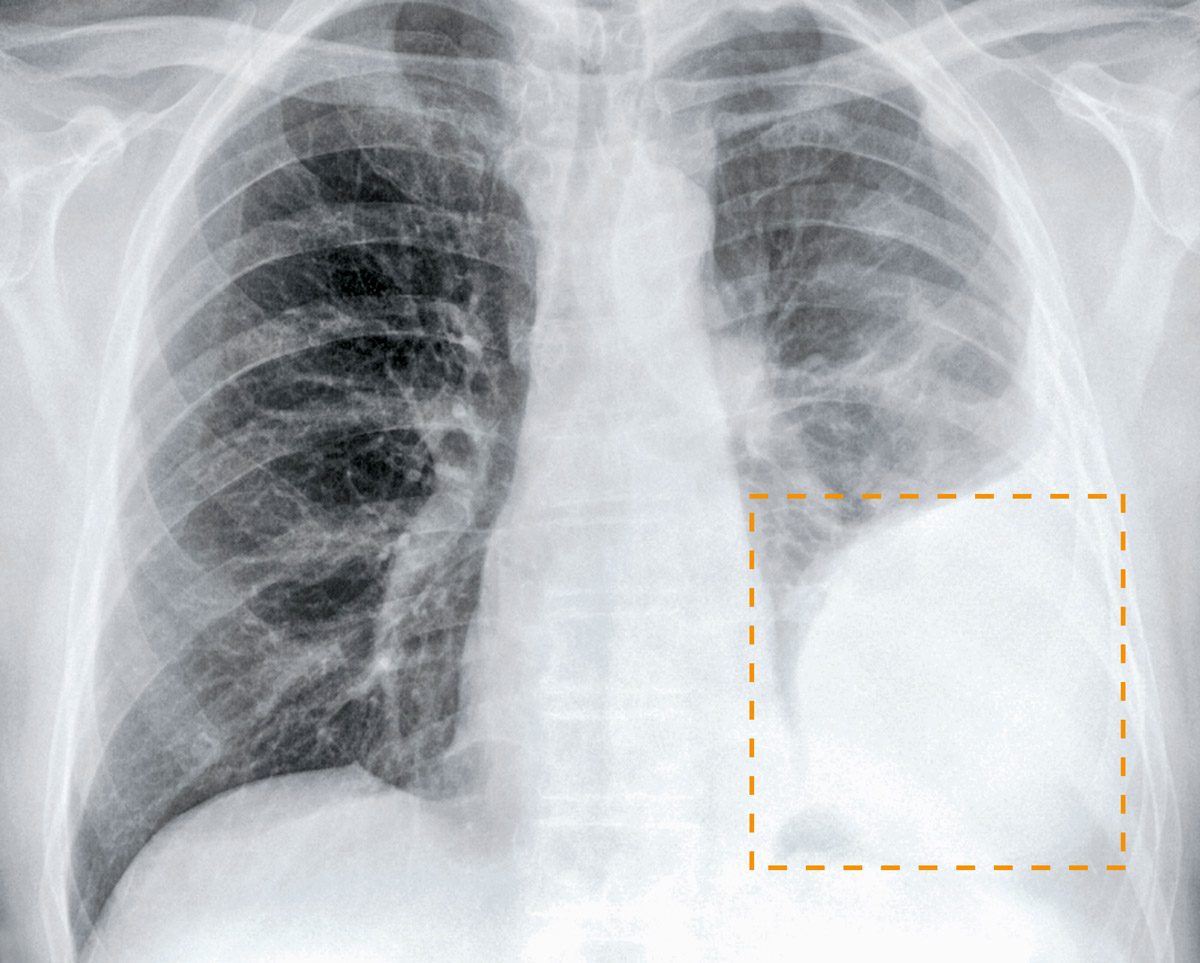 Der Brustfell-Tumor wächst schnell und aggressiv und führt unbehandelt innerhalb weniger Monate zum Tod. 80% der Brustfellkrebs-Fälle gehen auf das Konto von Asbest.