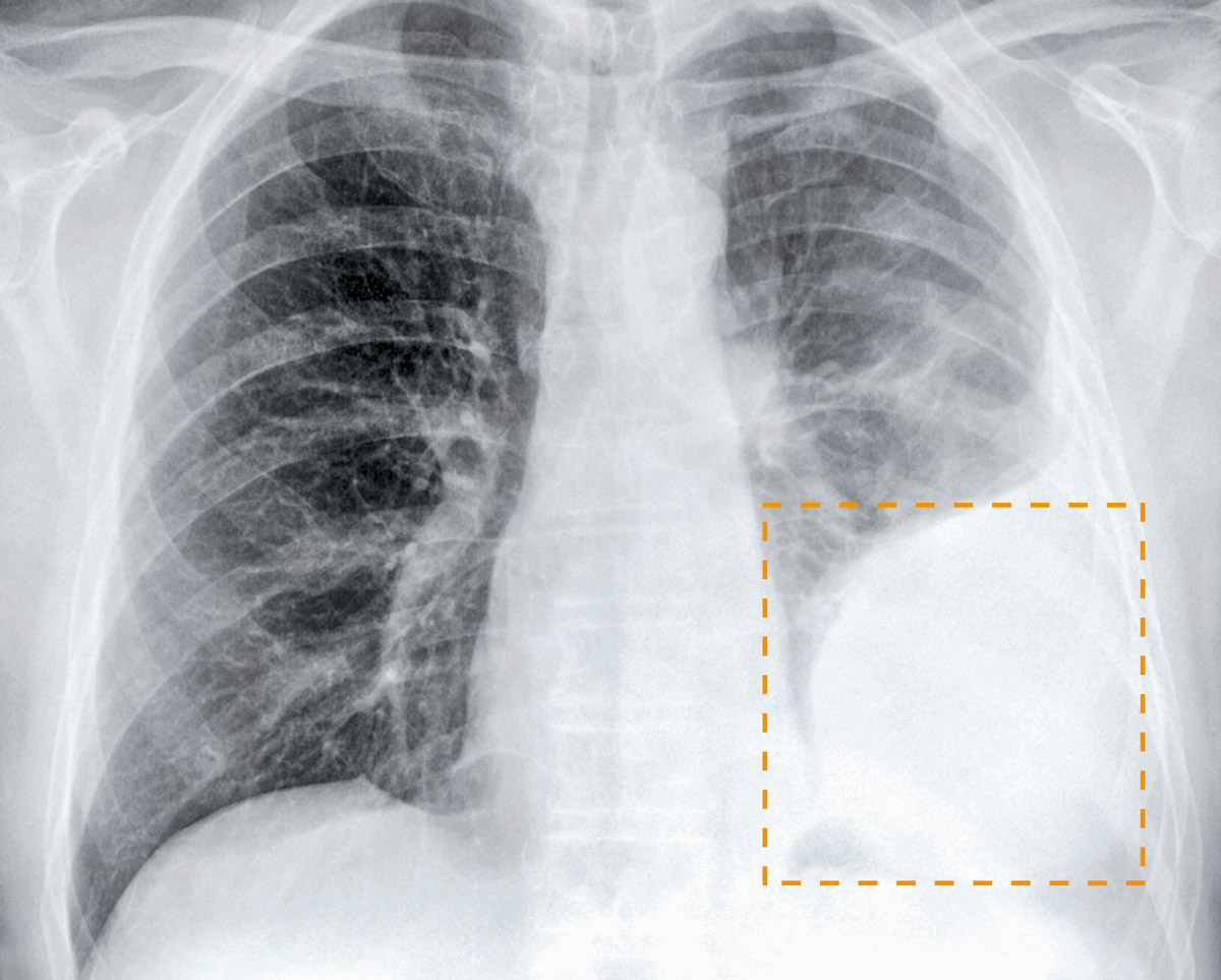 La tumeur de la plèvre se développe rapidement de manière agressive: sans traitement, elle est mortelle en quelques mois. L'amiante est responsable de 80 % des cas de cancer de la plèvre.